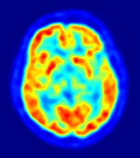Pet scan of a brain